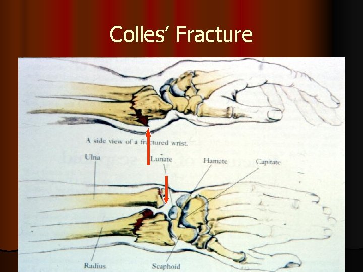 Colles’ Fracture 