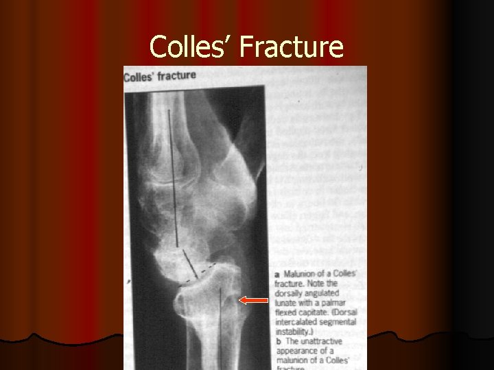 Colles’ Fracture 