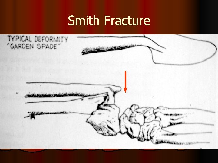 Smith Fracture 