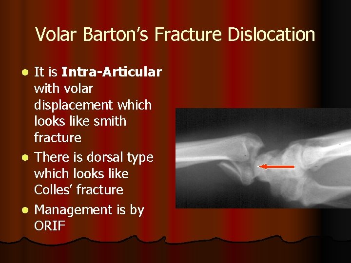 Volar Barton’s Fracture Dislocation It is Intra-Articular with volar displacement which looks like smith