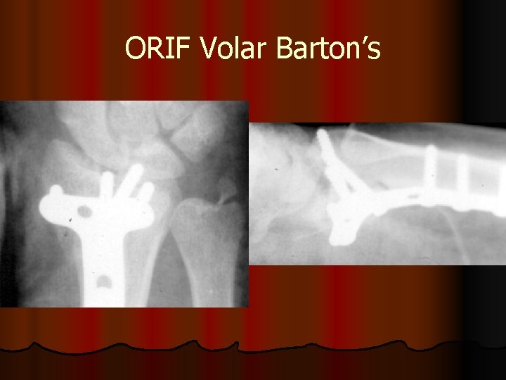 ORIF Volar Barton’s 