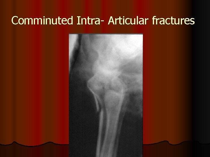 Comminuted Intra- Articular fractures 