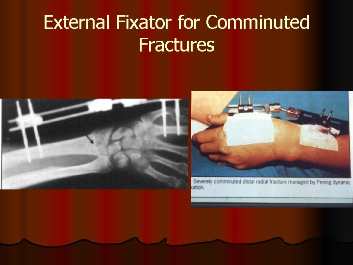 External Fixator for Comminuted Fractures 