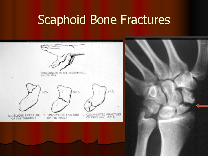 Scaphoid Bone Fractures 