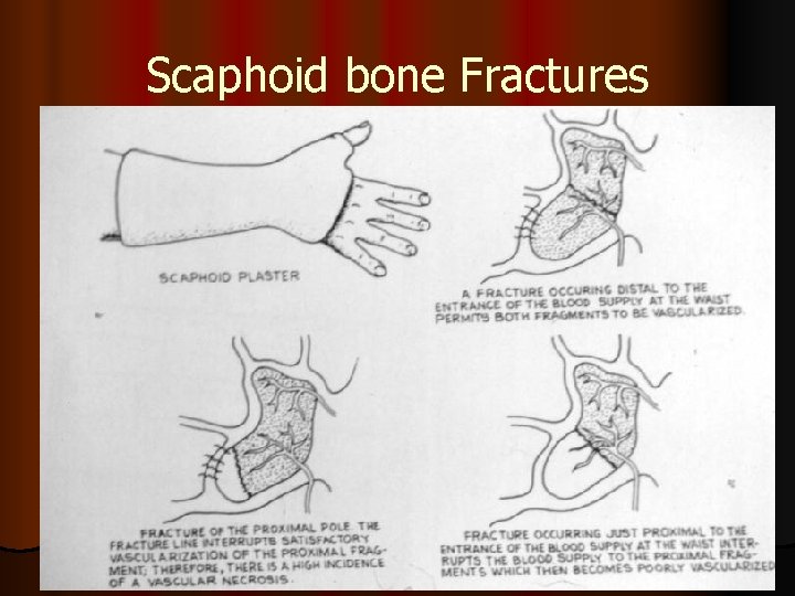 Scaphoid bone Fractures 