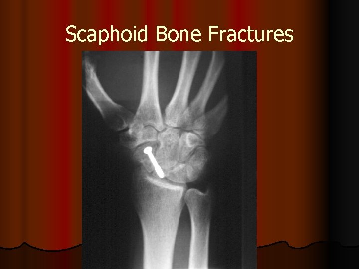 Scaphoid Bone Fractures 