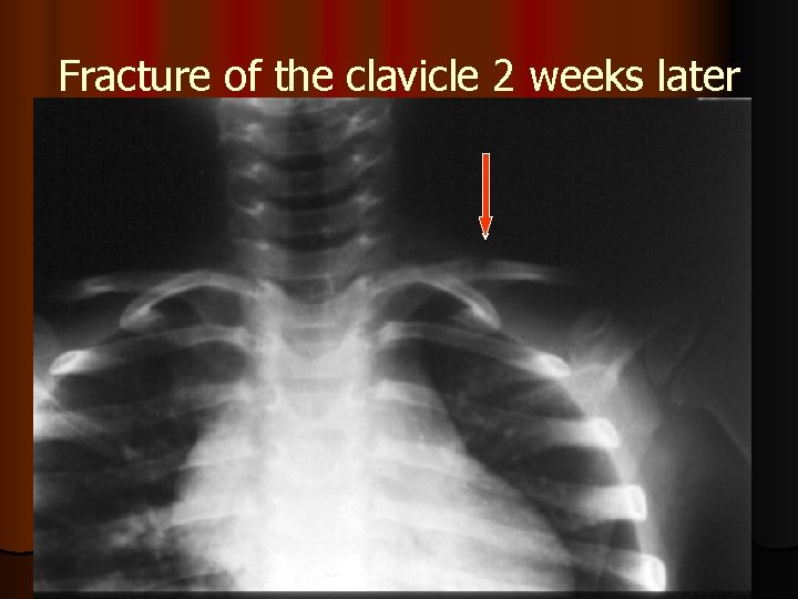 Fracture of the clavicle 2 weeks later 