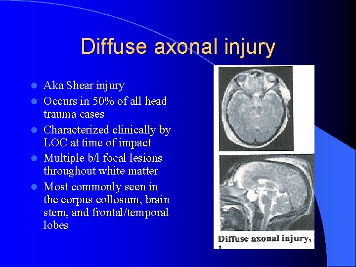 Diffuse axonal injury l l l Aka Shear injury Occurs in 50% of all