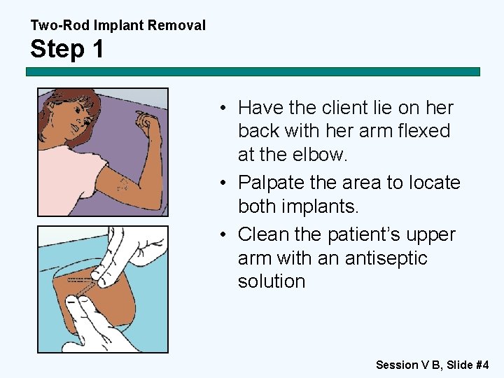 Two-Rod Implant Removal Step 1 • Have the client lie on her back with