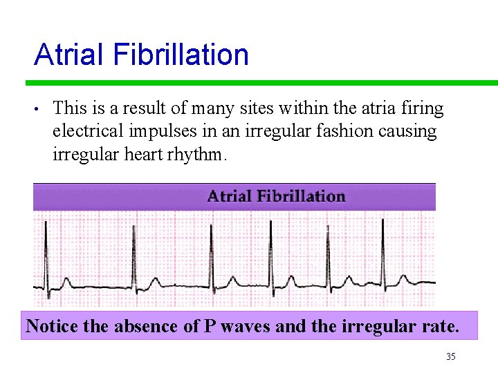 Atrial Fibrillation • This is a result of many sites within the atria firing