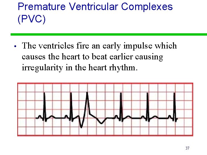 Premature Ventricular Complexes (PVC) • The ventricles fire an early impulse which causes the