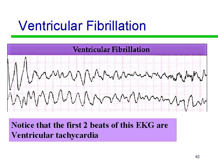Ventricular Fibrillation Notice that the first 2 beats of this EKG are Ventricular tachycardia