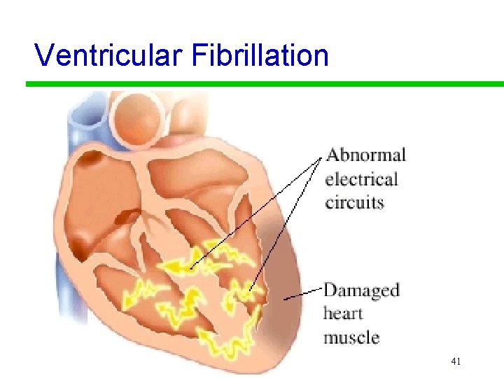 Ventricular Fibrillation 41 