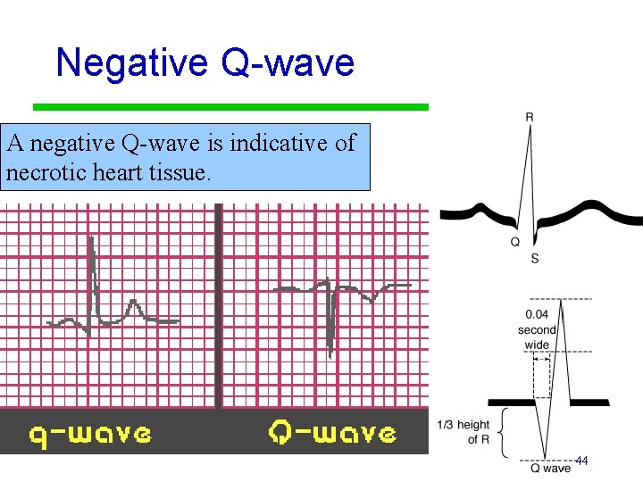 Negative Q-wave A negative Q-wave is indicative of necrotic heart tissue. 44 