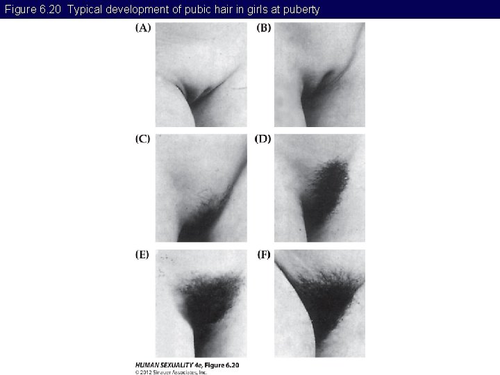Figure 6. 20 Typical development of pubic hair in girls at puberty 