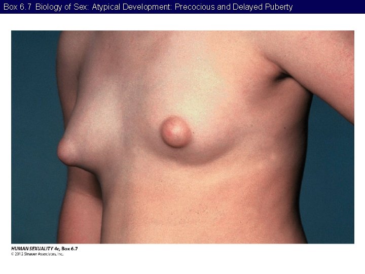 Box 6. 7 Biology of Sex: Atypical Development: Precocious and Delayed Puberty 