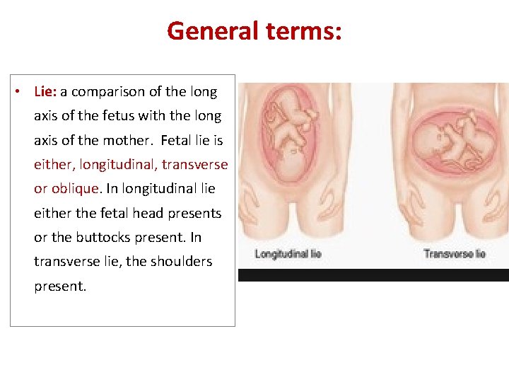 General terms: • Lie: a comparison of the long axis of the fetus with