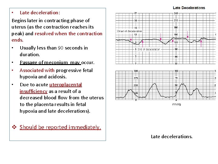  • Late deceleration: Begins later in contracting phase of uterus (as the contraction