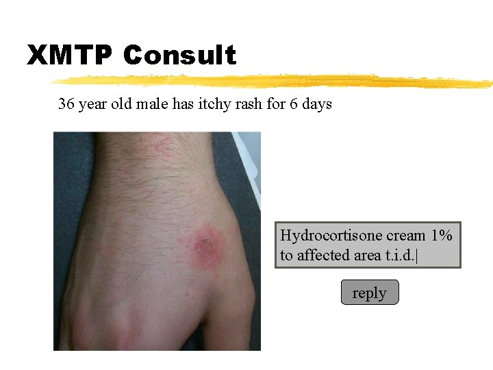 XMTP Consult 36 year old male has itchy rash for 6 days Hydrocortisone cream