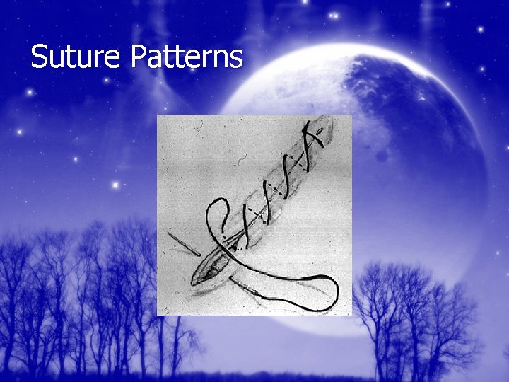 Suture Patterns 