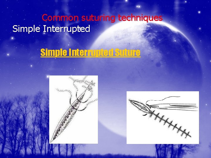 Common suturing techniques Simple Interrupted Suture 