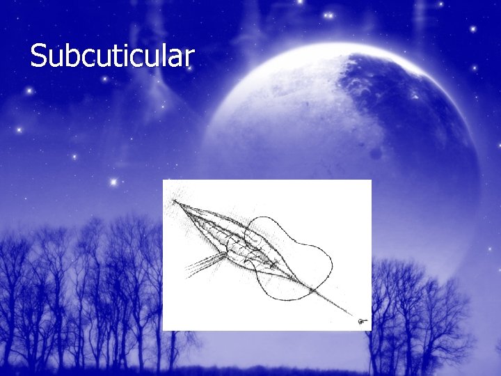 Subcuticular 