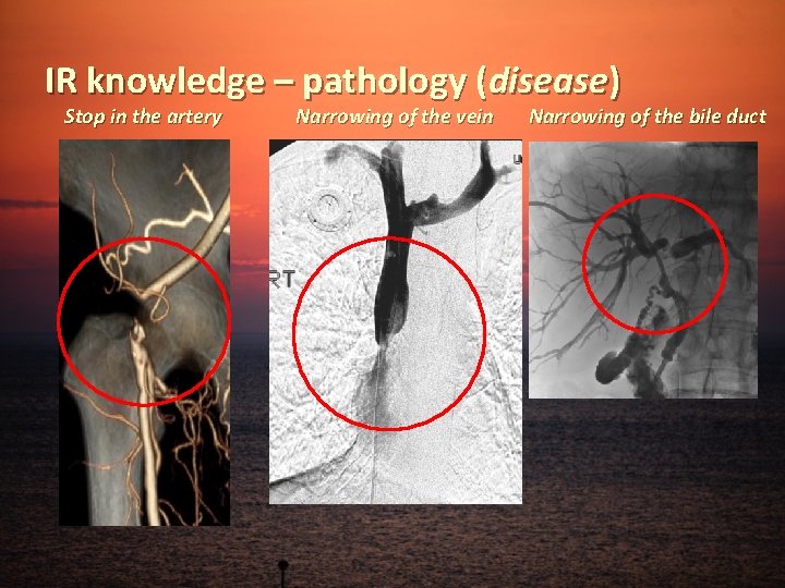 IR knowledge – pathology (disease) Stop in the artery Narrowing of the vein Narrowing