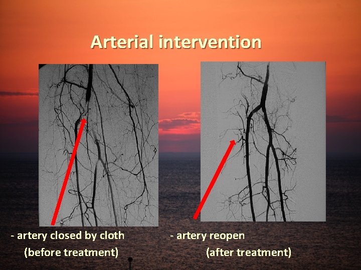 Arterial intervention - artery closed by cloth (before treatment) - artery reopen (after treatment)
