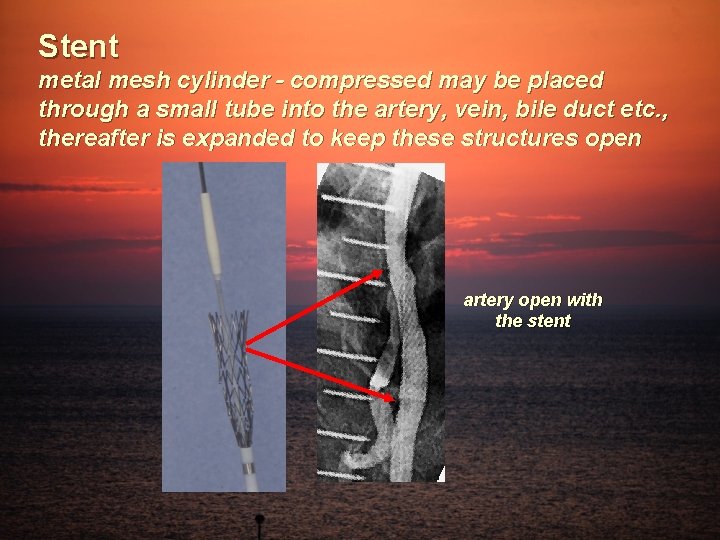 Stent metal mesh cylinder - compressed may be placed through a small tube into