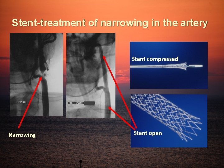 Stent-treatment of narrowing in the artery Stent compressed Narrowing Stent open 