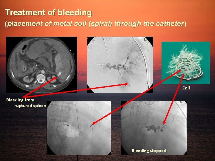 Treatment of bleeding (placement of metal coil (spiral) through the catheter) Coil Bleeding from
