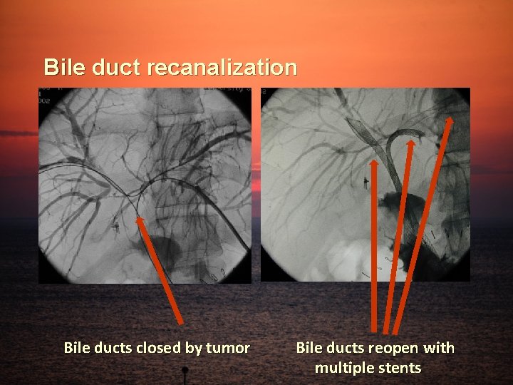 Bile duct recanalization Bile ducts closed by tumor Bile ducts reopen with multiple stents