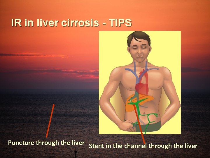 IR in liver cirrosis - TIPS Puncture through the liver Stent in the channel