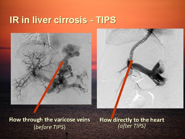 IR in liver cirrosis - TIPS Flow through the varicose veins (before TIPS) Flow