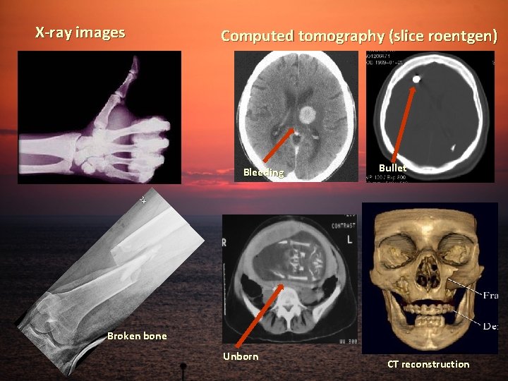 X-ray images Computed tomography (slice roentgen) Bleeding Bullet Broken bone Unborn CT reconstruction 
