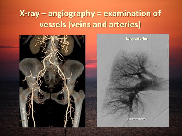 X-ray – angiography = examination of vessels (veins and arteries) Lung arteries 