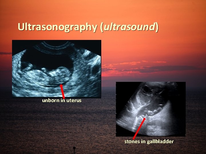 Ultrasonography (ultrasound) unborn in uterus stones in gallbladder 