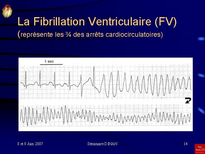 La Fibrillation Ventriculaire (FV) (représente les ¾ des arrêts cardiocirculatoires) 8 et 9 Juin