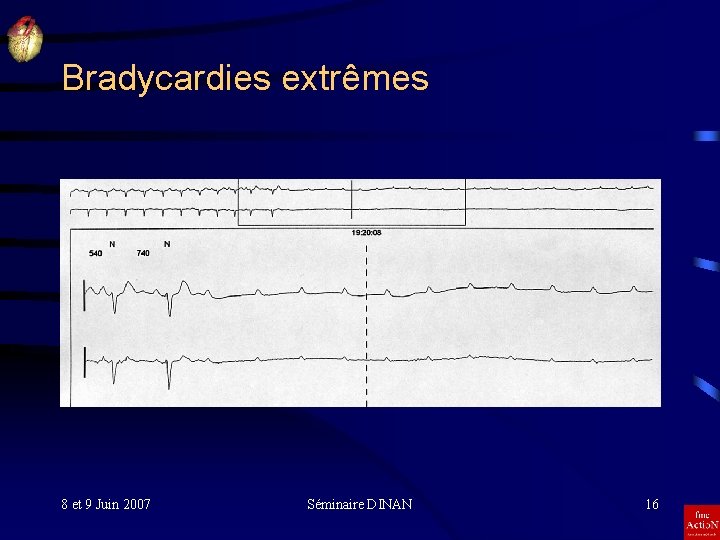 Bradycardies extrêmes 8 et 9 Juin 2007 Séminaire DINAN 16 