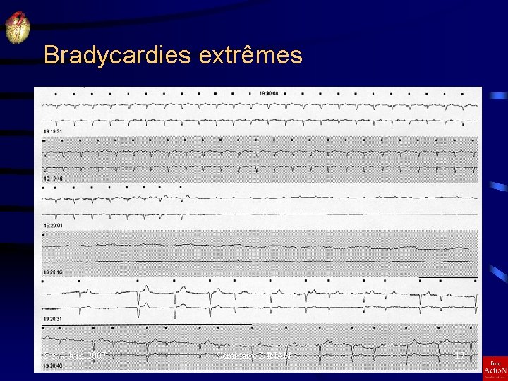 Bradycardies extrêmes 8 et 9 Juin 2007 Séminaire DINAN 17 
