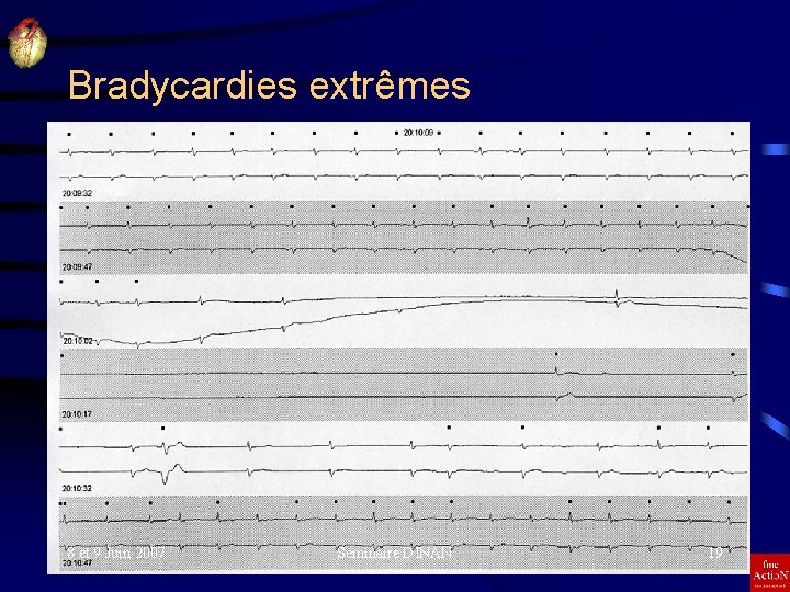 Bradycardies extrêmes 8 et 9 Juin 2007 Séminaire DINAN 19 