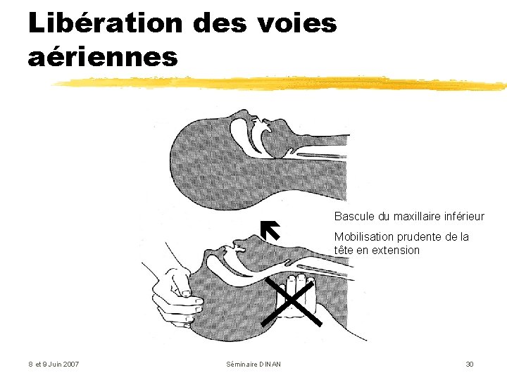 Libération des voies aériennes 8 et 9 Juin 2007 Séminaire DINAN Bascule du maxillaire