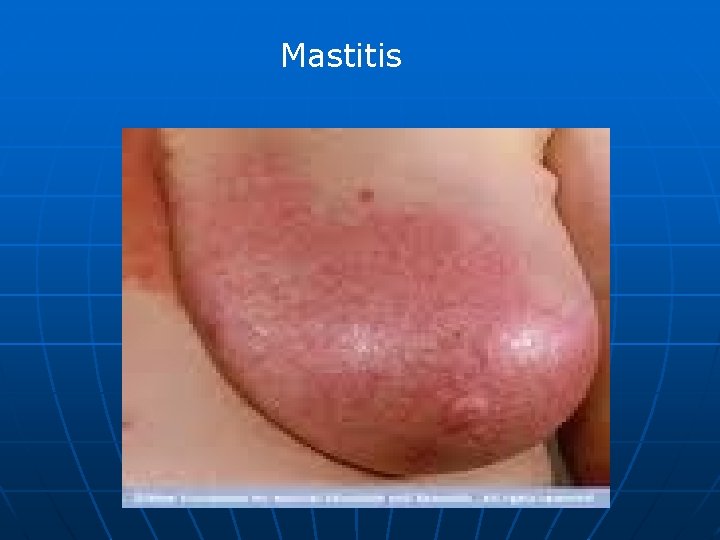 Mastitis 