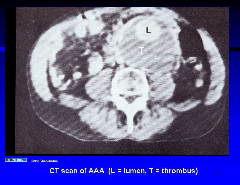 Source Undetermined CT scan of AAA (L = lumen, T = thrombus) 10 