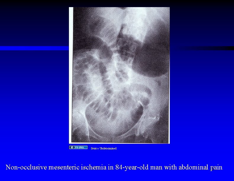 Source Undetermined Non-occlusive mesenteric ischemia in 84 -year-old man with abdominal 16 pain 