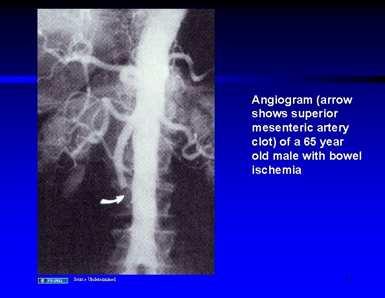 Angiogram (arrow shows superior mesenteric artery clot) of a 65 year old male with