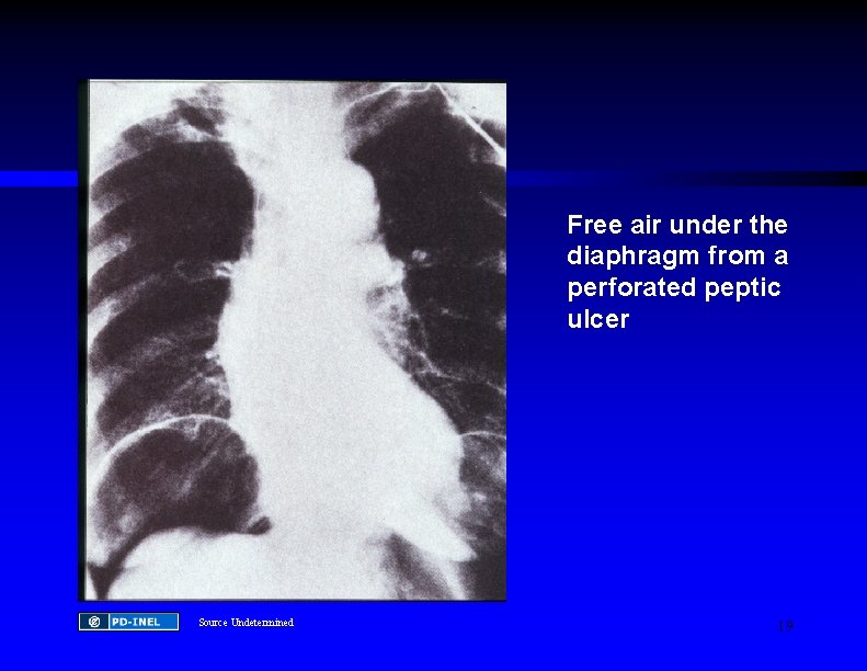 Free air under the diaphragm from a perforated peptic ulcer Source Undetermined 19 