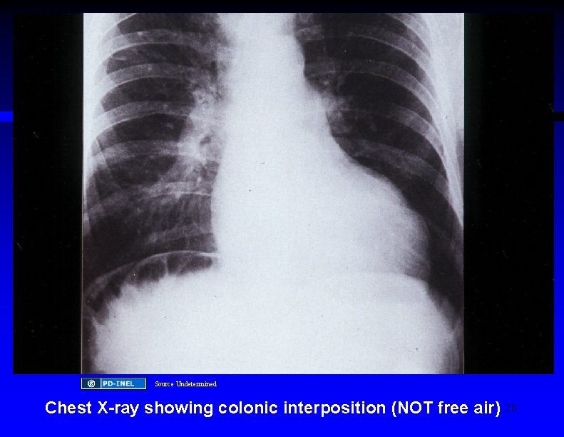 Source Undetermined Chest X-ray showing colonic interposition (NOT free air) 20 