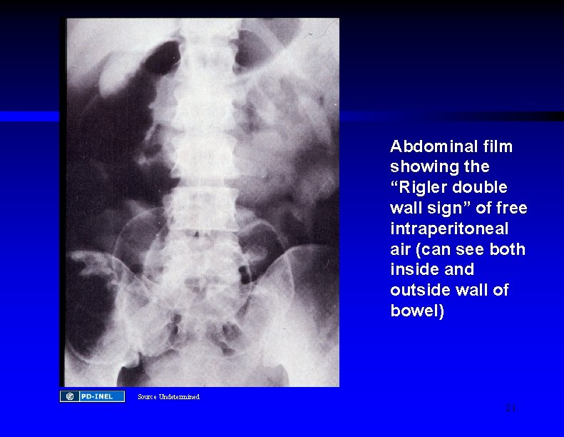 Abdominal film showing the “Rigler double wall sign” of free intraperitoneal air (can see