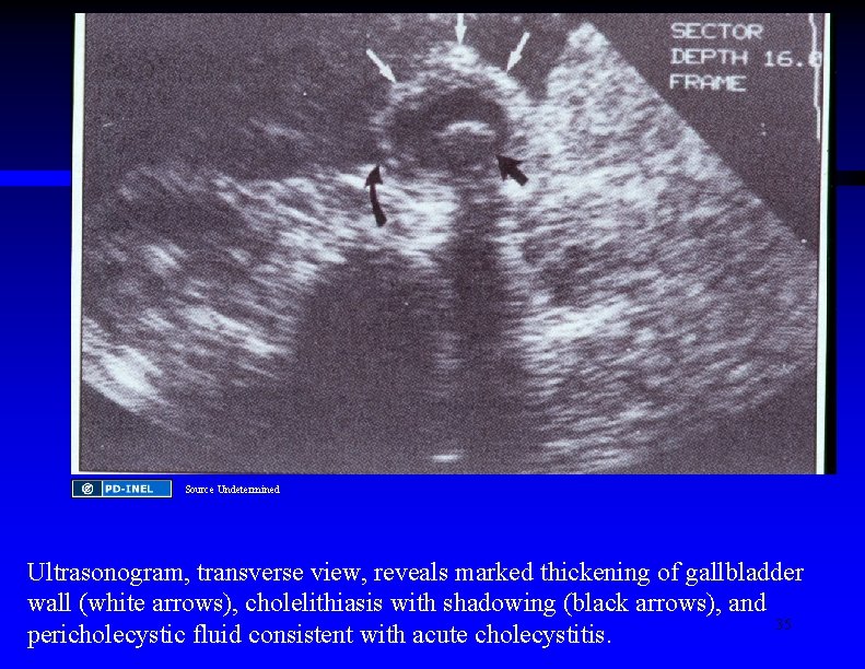 Source Undetermined Ultrasonogram, transverse view, reveals marked thickening of gallbladder wall (white arrows), cholelithiasis